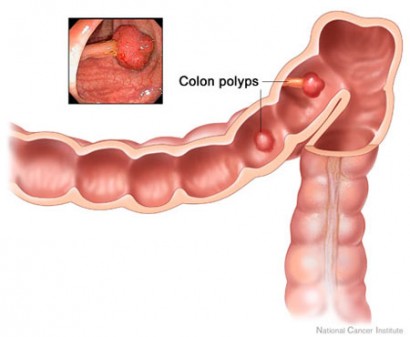 Colon_Polyps 2