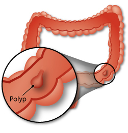 polyp 3
