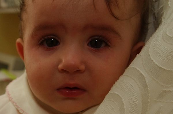 הדרך הטבעית למניעת והקלת אלרגיה אצל ילדים