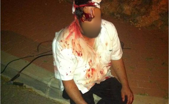 מצבו של היהודי שנפגע בראשו מאבן ממשיך להיות קשה