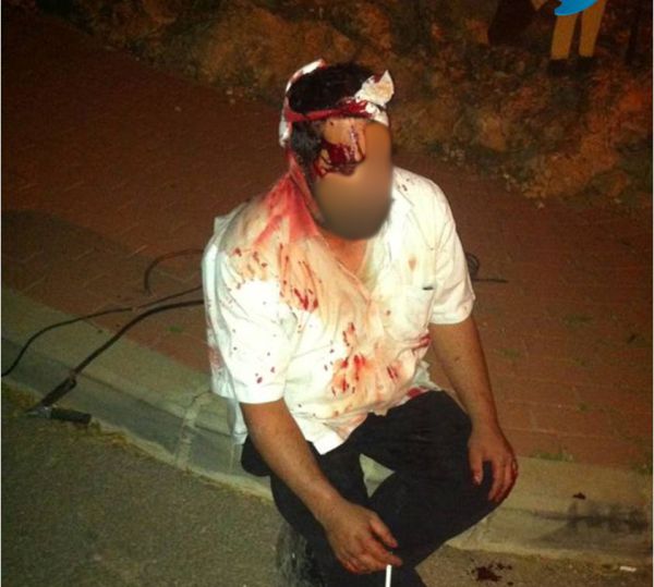 מצבו של היהודי שנפגע בראשו מאבן ממשיך להיות קשה