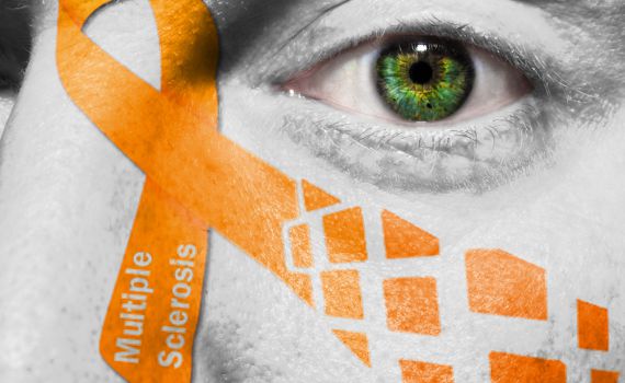 בעל שלקה בטרשת נפוצה נתן גט לאשתו על-ידי מצמוץ