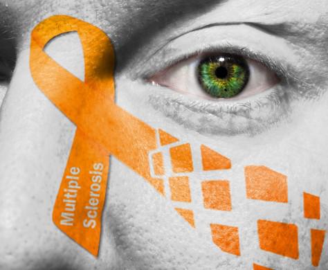 טיפול חדשני אושר לחולי טרשת נפוצה