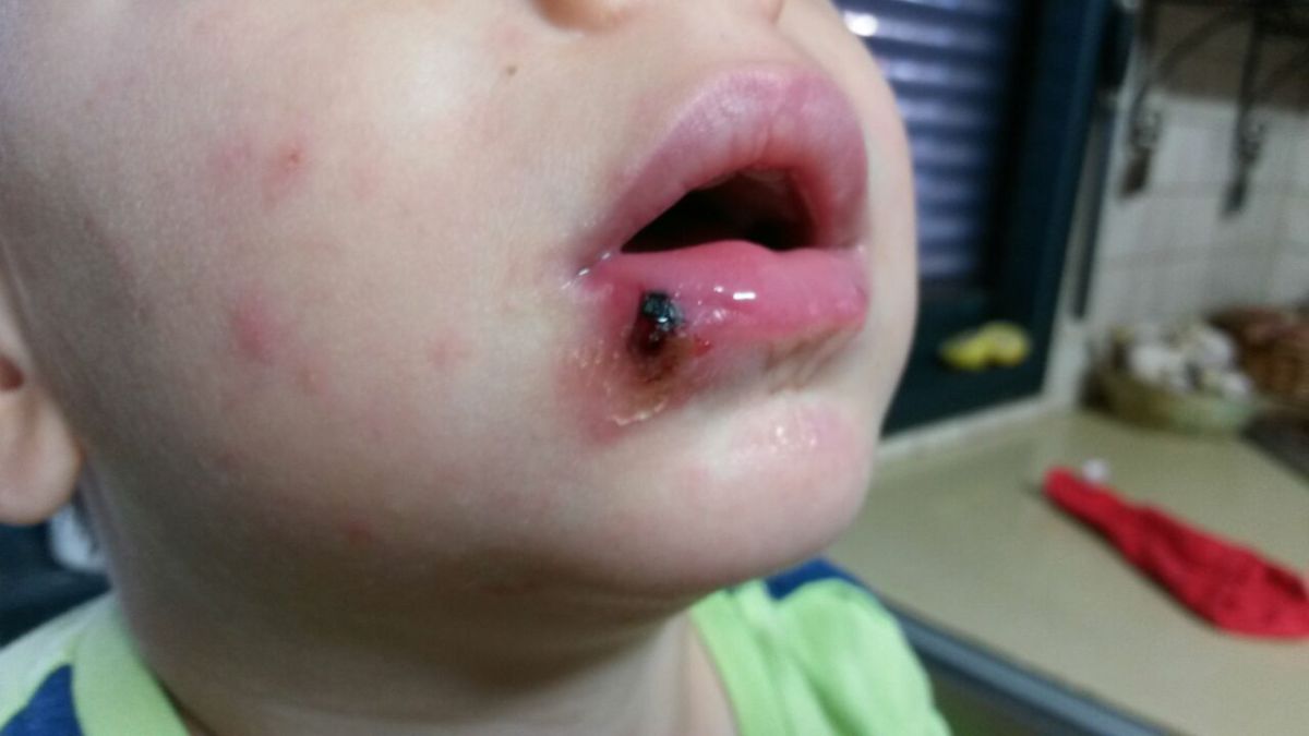 מגפת לישמניה בשומרון; הרשויות לא נותנות פתרון