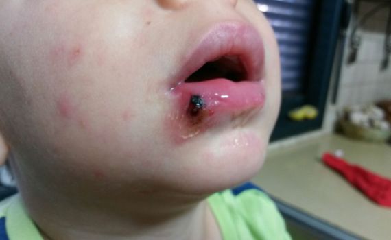 מגפת הלישמניה ביו"ש סוף סוף בדרך לפתרון