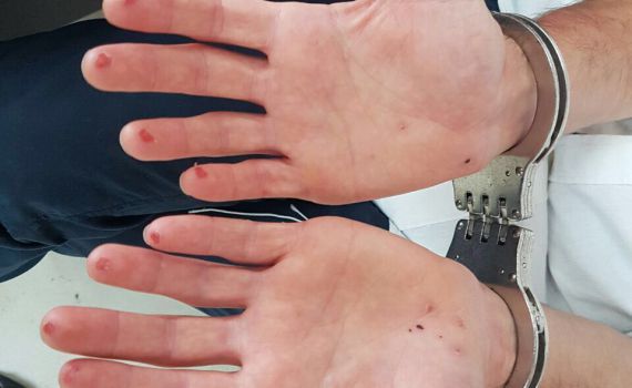 נתפס וחתך את האצבעות כדי למנוע זיהוי. צפו