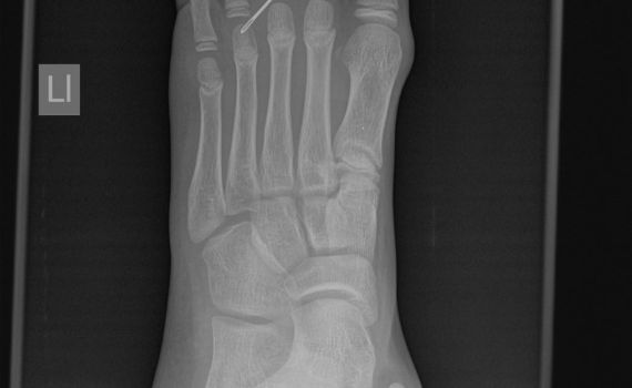 המחט חדרה לכף הרגל של הילד ונשברה