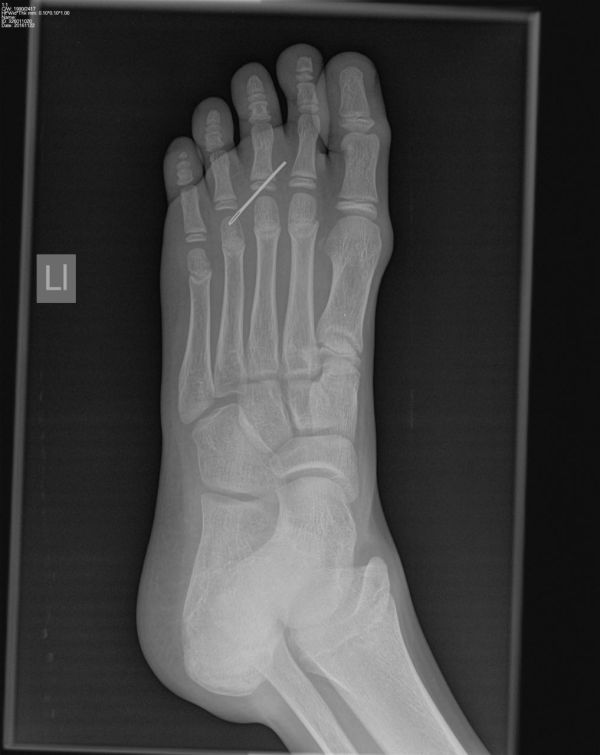 המחט חדרה לכף הרגל של הילד ונשברה