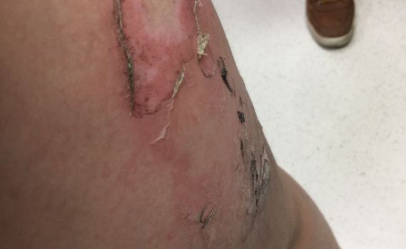 הסלולרי התפוצץ בכיס ילד בן תשע נכווה קשות