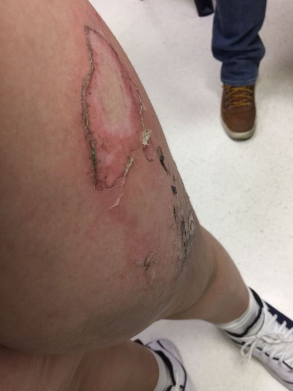 הסלולרי התפוצץ בכיס ילד בן תשע נכווה קשות