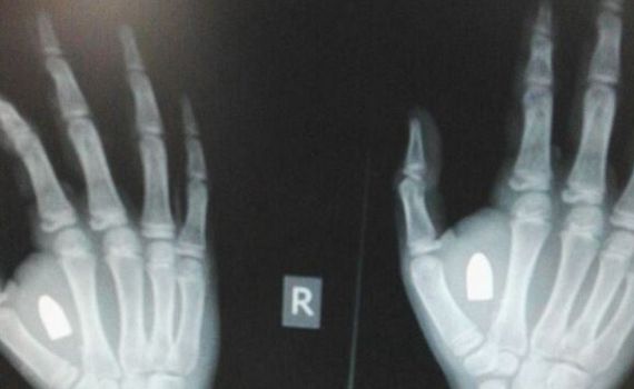 הזוי: ילד התלונן על נפיחות, הרופאים מצאו ביד קליע