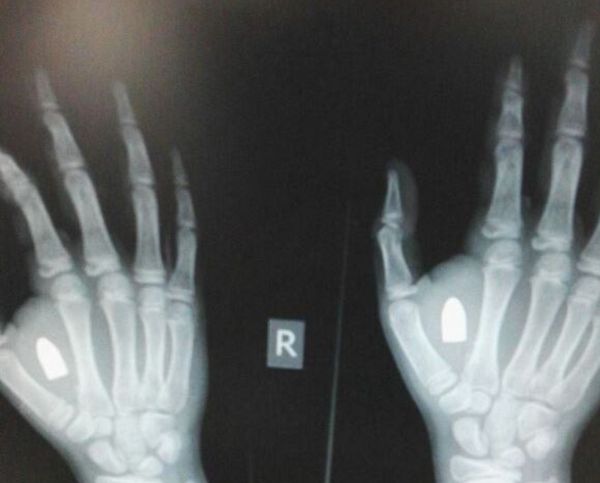 הזוי: ילד התלונן על נפיחות, הרופאים מצאו ביד קליע