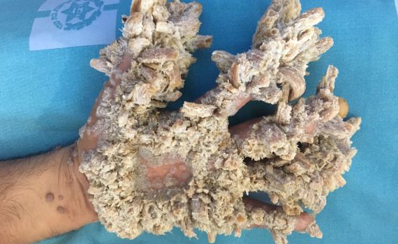 הרופאים בהדסה הצילו את ידו של "איש העץ"