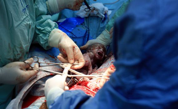 מעייני הישועה: ניתוח קיסרי מספר 10 לאישה אחת