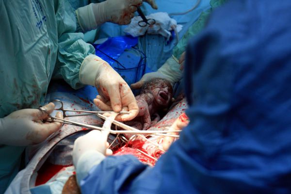 מעייני הישועה: ניתוח קיסרי מספר 10 לאישה אחת