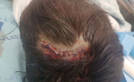 הילד שנפצע בחברון משחזר:"בוא,זרקו עליך אבן"