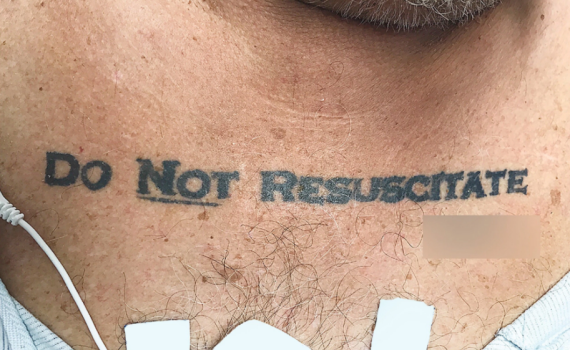 הלם: בעקבות קעקוע- רופאים נתנו לחולה למות