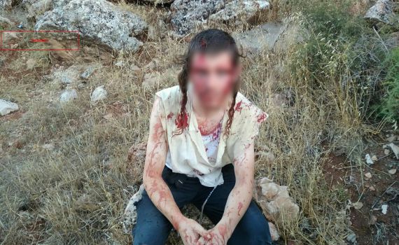 'כמעט מת': הצעיר היהודי שעבר לינץ' שוחרר מביה"ח