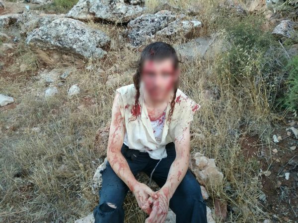 'כמעט מת': הצעיר היהודי שעבר לינץ' שוחרר מביה"ח