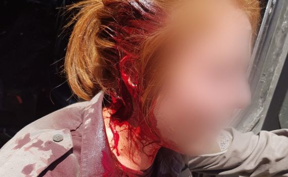 בושה: נערי גבעות פצעו חיילת מג"ב בראשה. צפו