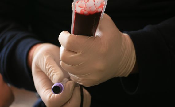 לפני פסח: מד"א מזהיר מפני מחסור חמור בדם