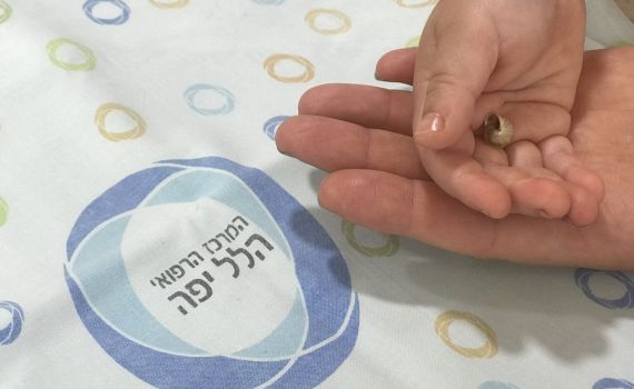 חילוץ דרמטי: חילזון הוצא מאפו של פעוט בן שלוש