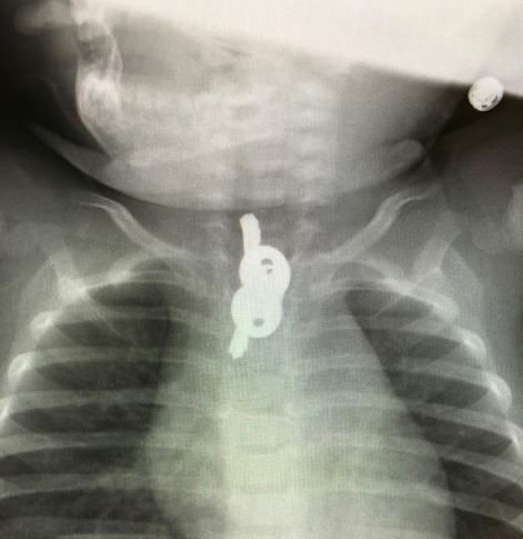 ההורים פנו עם בנם למיון ומצאו "הפתעה" בבטנו