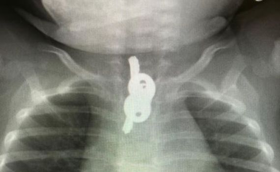 ההורים פנו עם בנם למיון ומצאו "הפתעה" בבטנו