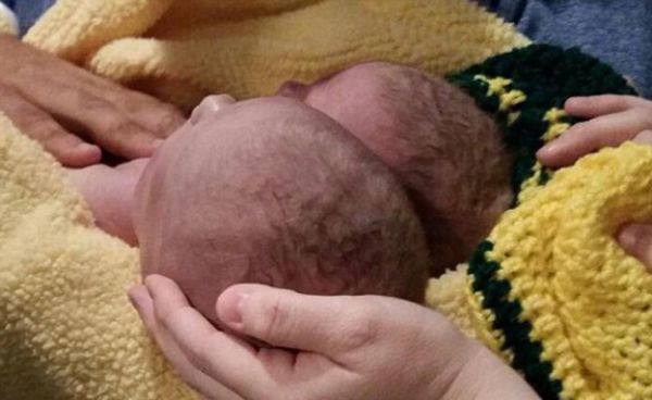 הודו: אישה ילדה תינוק בעל שני ראשים. צפו