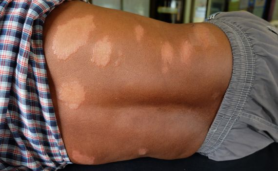 קצר על הפרשה | דיני צרעת ועולמנו הדתי והמוסרי • צפו: