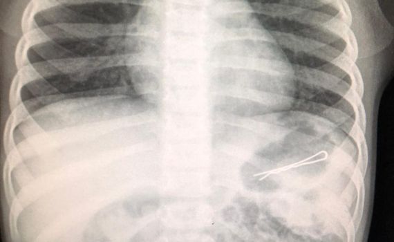 בן 3 ניצל כשמגופו נשלפה סיכה באורך 6 ס"מ