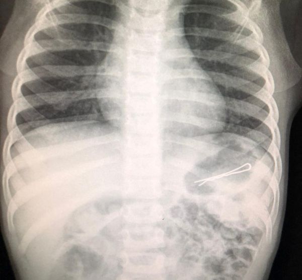 בן 3 ניצל כשמגופו נשלפה סיכה באורך 6 ס"מ