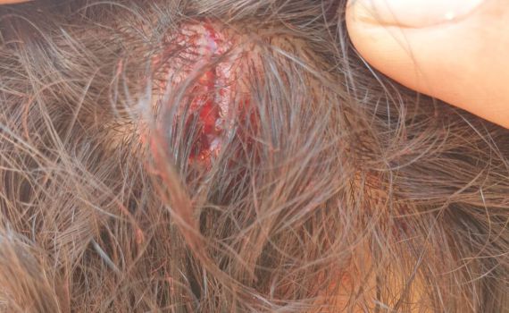 צעיר הותקף על ידי ערבים בחברון, נפצע קל בראשו