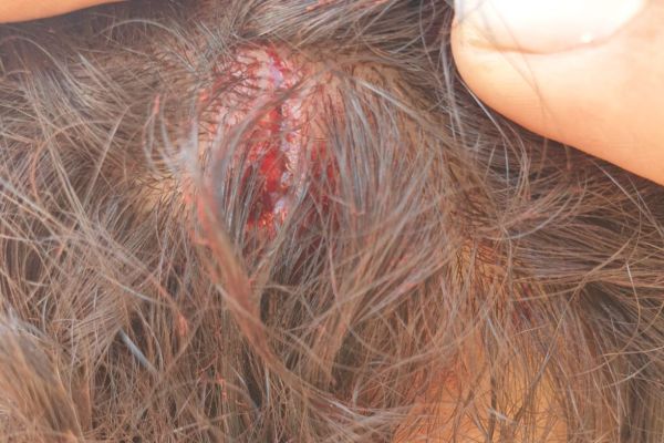 צעיר הותקף על ידי ערבים בחברון, נפצע קל בראשו