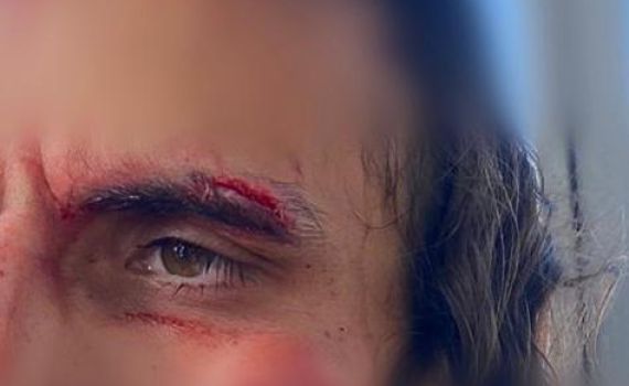 לינץ' בירושלים: פורעים ערבים תקפו חרדי