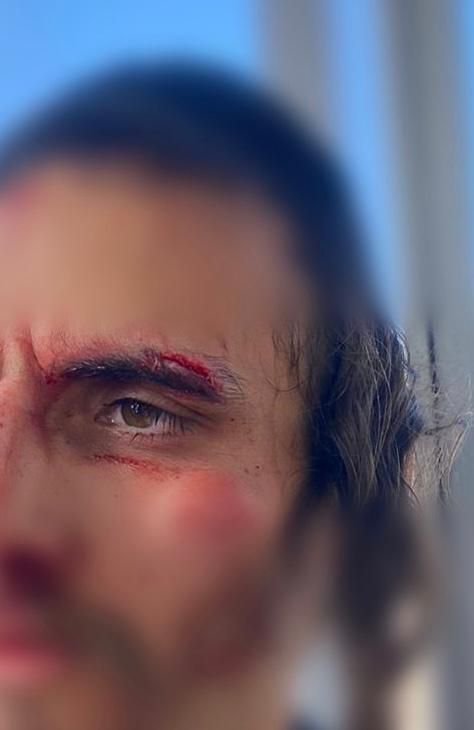 לינץ' בירושלים: פורעים ערבים תקפו חרדי