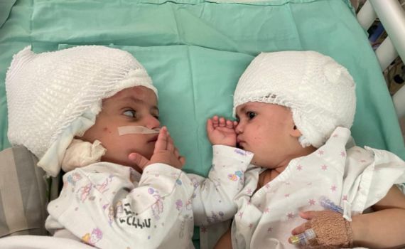 לראשונה בישראל, תאומות סיאמיות הופרדו בניתוח מורכב