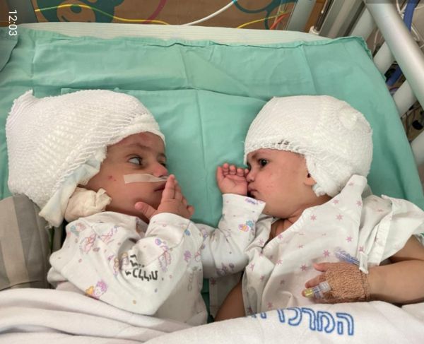 לראשונה בישראל, תאומות סיאמיות הופרדו בניתוח מורכב