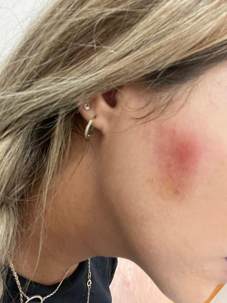 סיוט במספרה: נכוותה מחומר להחלקת שיער