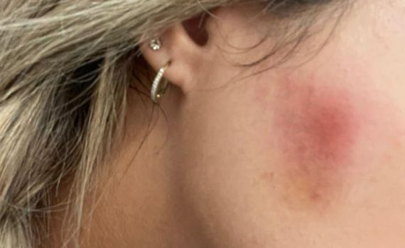 סיוט במספרה: נכוותה מחומר להחלקת שיער