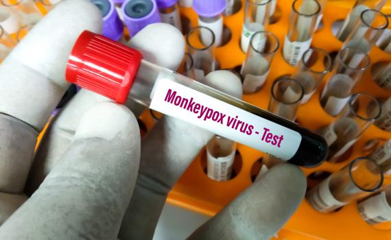 אבעבועות הקוף: 14 מקרים חדשים זוהו בבריטניה