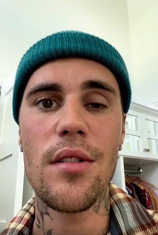 ג'סטין ביבר חושף כי חצי מפניו משותקות