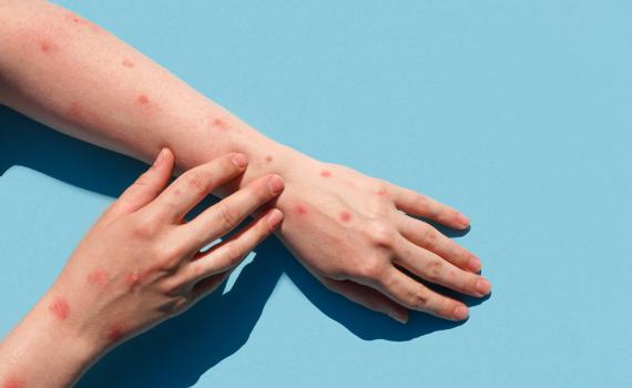 אבעבועות הקוף: בניו יורק הוכרז על מצב חרום