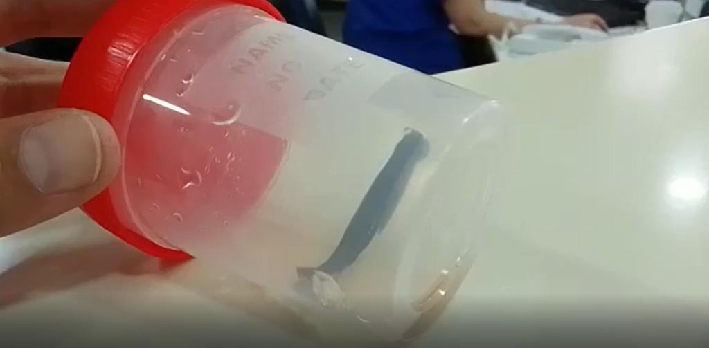 בן 8 טייל במעיין וגילה שעלוקה נדבקה לו לחיך