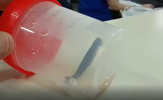 בן 8 טייל במעיין וגילה שעלוקה נדבקה לו לחיך