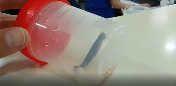 בן 8 טייל במעיין וגילה שעלוקה נדבקה לו לחיך