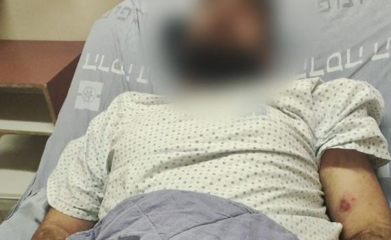 ירושלים: שני אחים נפצעו בקטטה עם פועלים ערבים