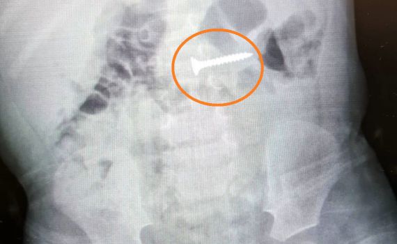 פעוט כבן שנה בלע בורג וניצל בזכות אימו