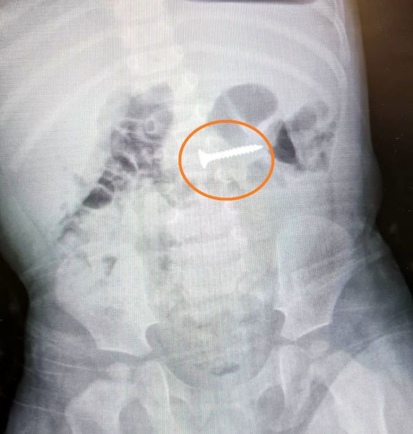 פעוט כבן שנה בלע בורג וניצל בזכות אימו