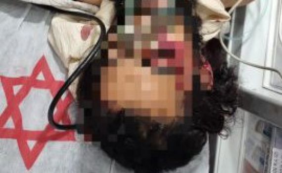 פצוע הלינץ' מהר חברון שב להכרה; מצבו קשה